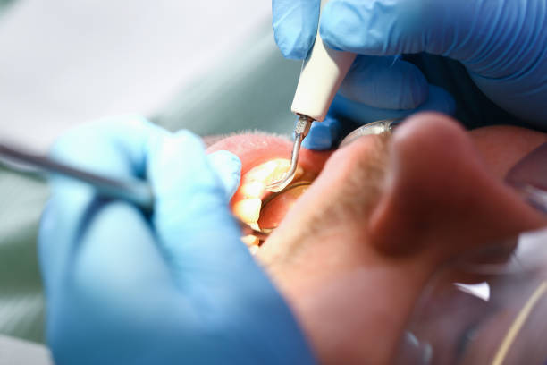Best Dental Abscess Treatment in Morgan Hill, CA